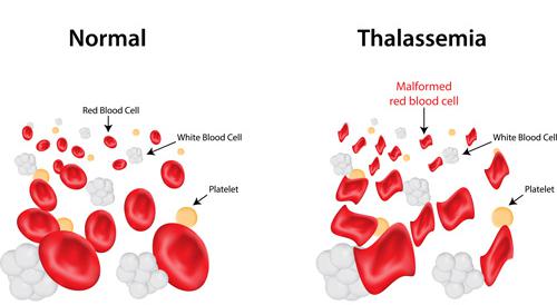 What is Thalassaemia?