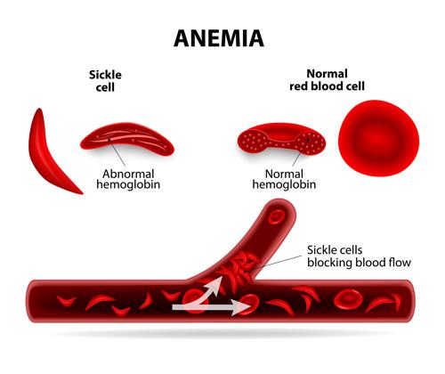 What Is Sickle Cell Disease?
